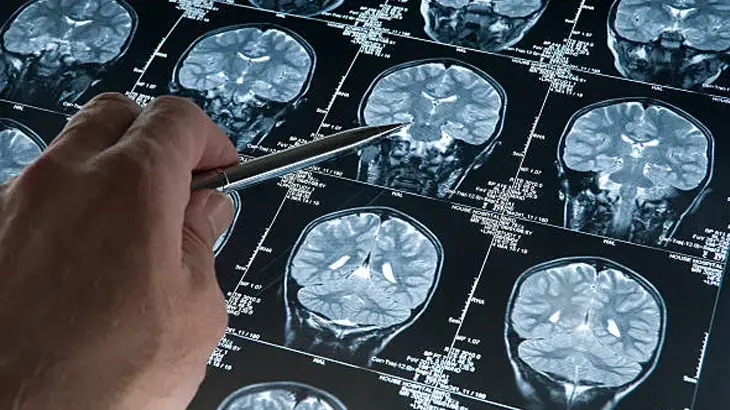 Alzheimer tedavisinde yeni dönem; antikor tedavisi evde uygulanabilecek